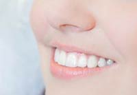 Teeth Whitening